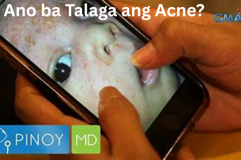 Ano ba Talaga ang Acne